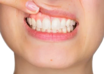 Periodontoloji Uzmanı Uyardı: Diş Eti Çekilmesinin En Büyük Sebebi Diş Taşı Birikimi