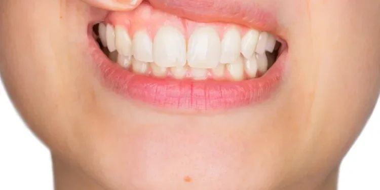 Periodontoloji Uzmanı Uyardı: Diş Eti Çekilmesinin En Büyük Sebebi Diş Taşı Birikimi